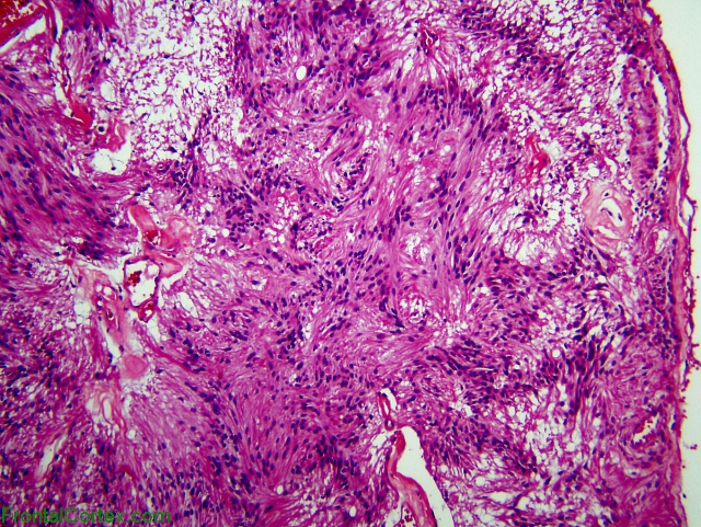 Myxopapillary ependymoma, H&E stain x100